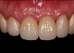 インプラントと天然歯の混在 審美症例1 セット