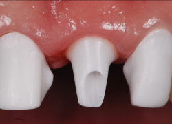 インプラントと天然歯の混在 審美症例1 Zrアバットメント