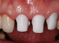 インプラントと天然歯の混在 審美症例1 コーピング