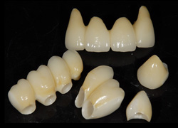 インプラントと天然歯の混在 審美症例2　補綴物