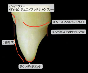 支台歯基本形成　前歯